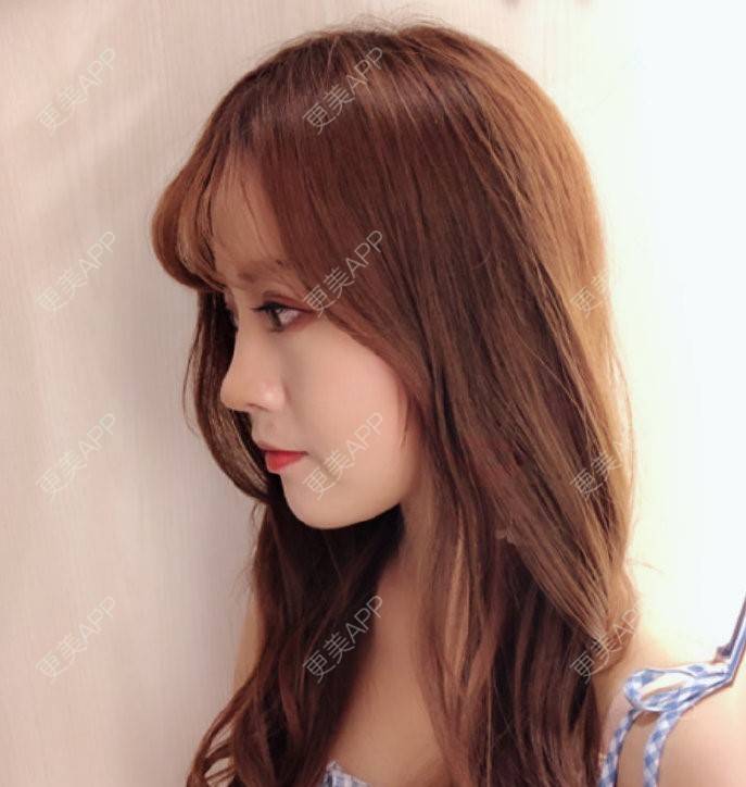 更美 - 准则的全切双眼皮经验 | 杭州 | 全切双眼皮