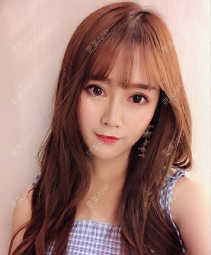 更美 - 准则的全切双眼皮经验 | 杭州 | 全切双眼皮