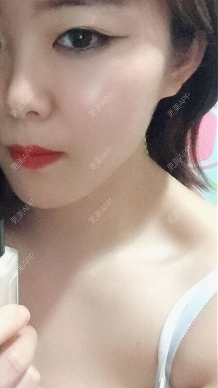 更美 - 蕶亂の嗳杀的手术除腋臭经验 | 北京 | 手术除腋臭
