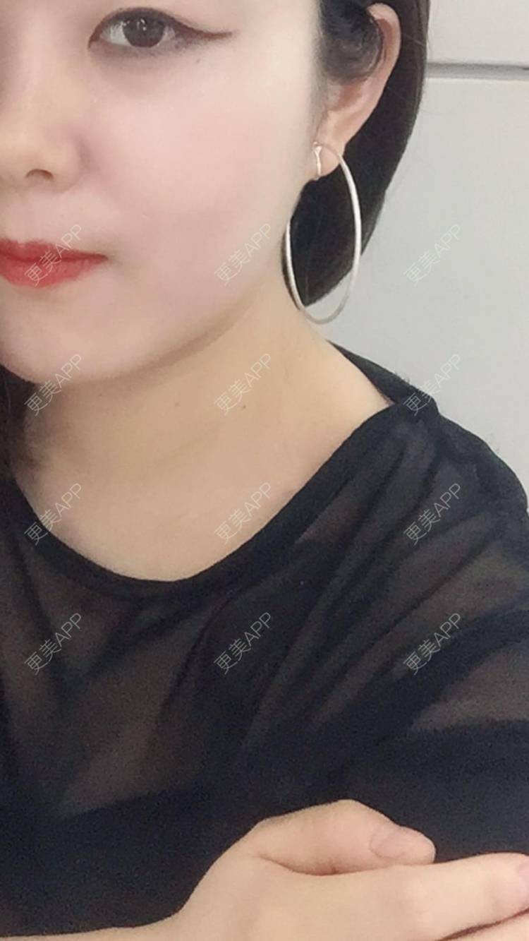更美 - 蕶亂の嗳杀的手术除腋臭经验 | 北京 | 手术除腋臭