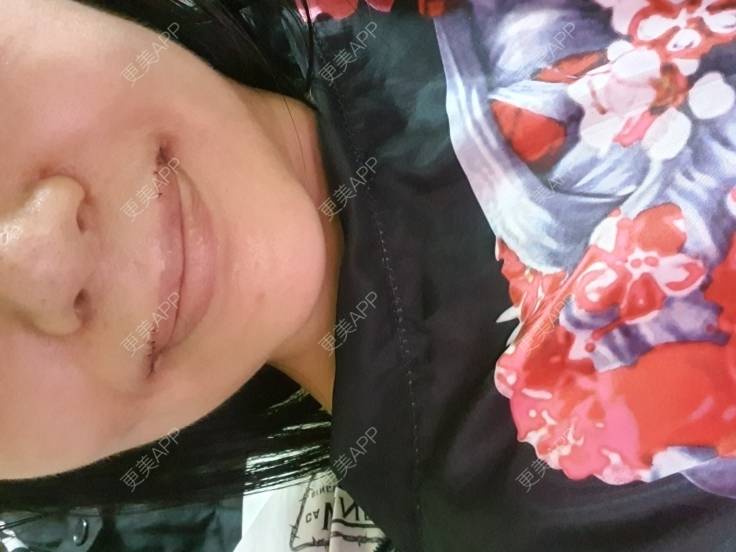 更美 - 傲小娇的厚唇改薄经验 | 厚唇改薄 | 深圳
