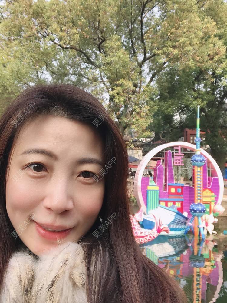 更美 - 更美用户bONdGip4QS的双眼皮经验 | 双眼皮 | 上海 | 眼部多项