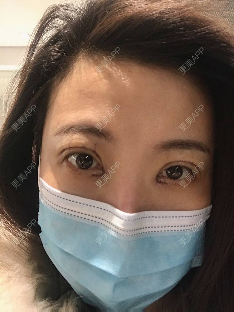 更美 - 更美用户bONdGip4QS的双眼皮经验 | 双眼皮 | 上海 | 眼部多项