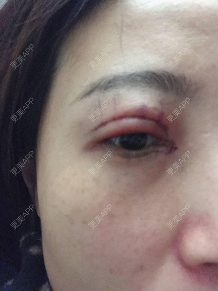 更美 - 更美用户bONdGip4QS的双眼皮经验 | 双眼皮 | 上海 | 眼部多项