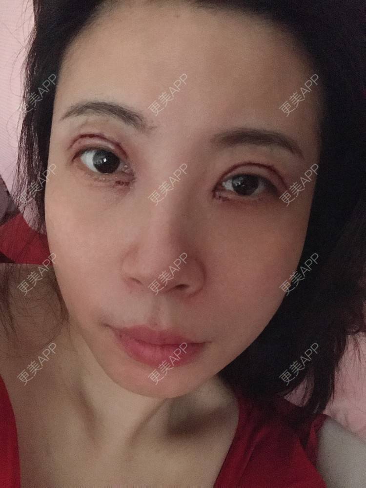 更美 - 更美用户bONdGip4QS的双眼皮经验 | 双眼皮 | 上海 | 眼部多项