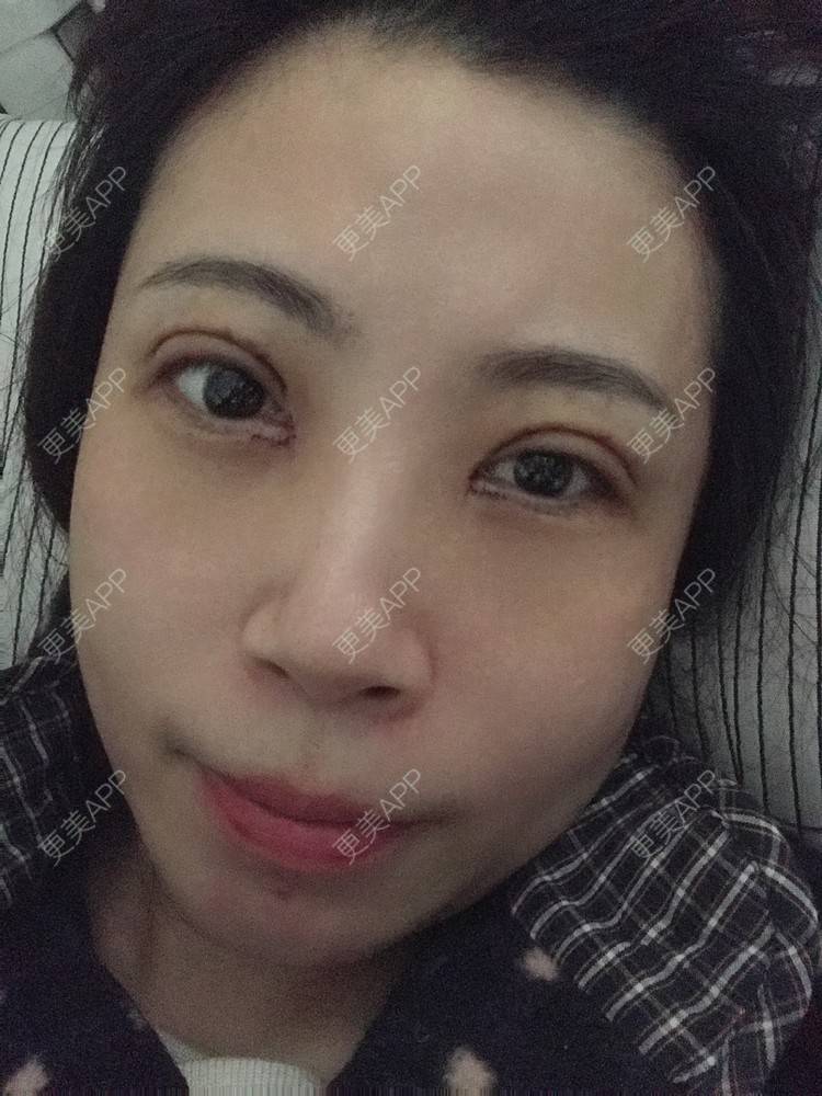 更美 - 更美用户bONdGip4QS的双眼皮经验 | 双眼皮 | 上海 | 眼部多项