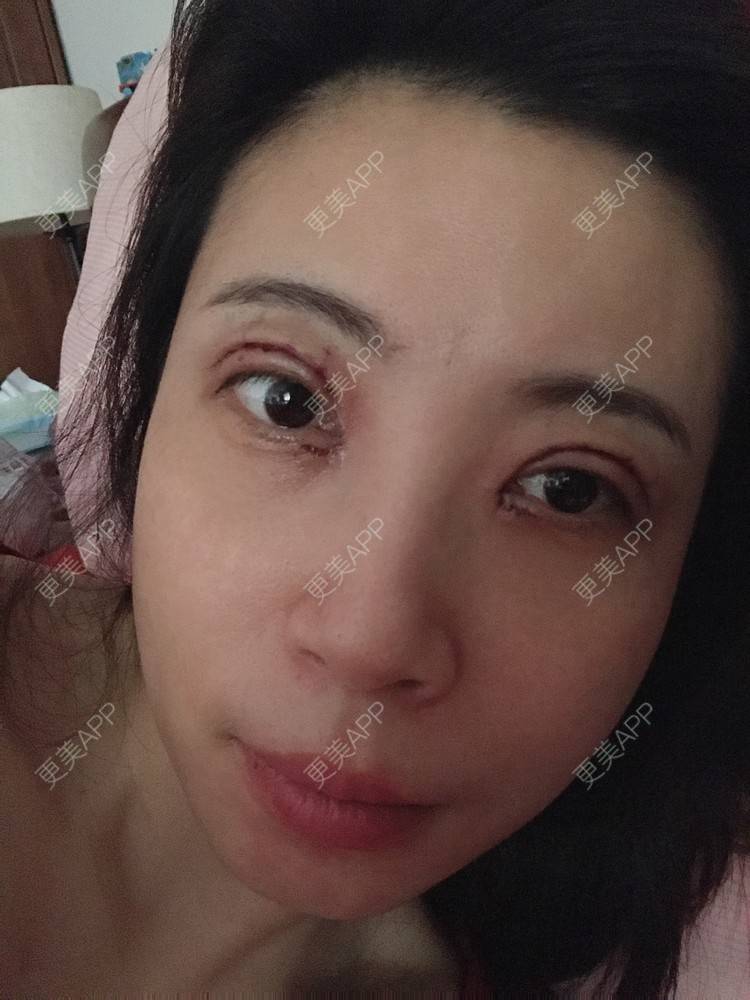 更美 - 更美用户bONdGip4QS的双眼皮经验 | 双眼皮 | 上海 | 眼部多项