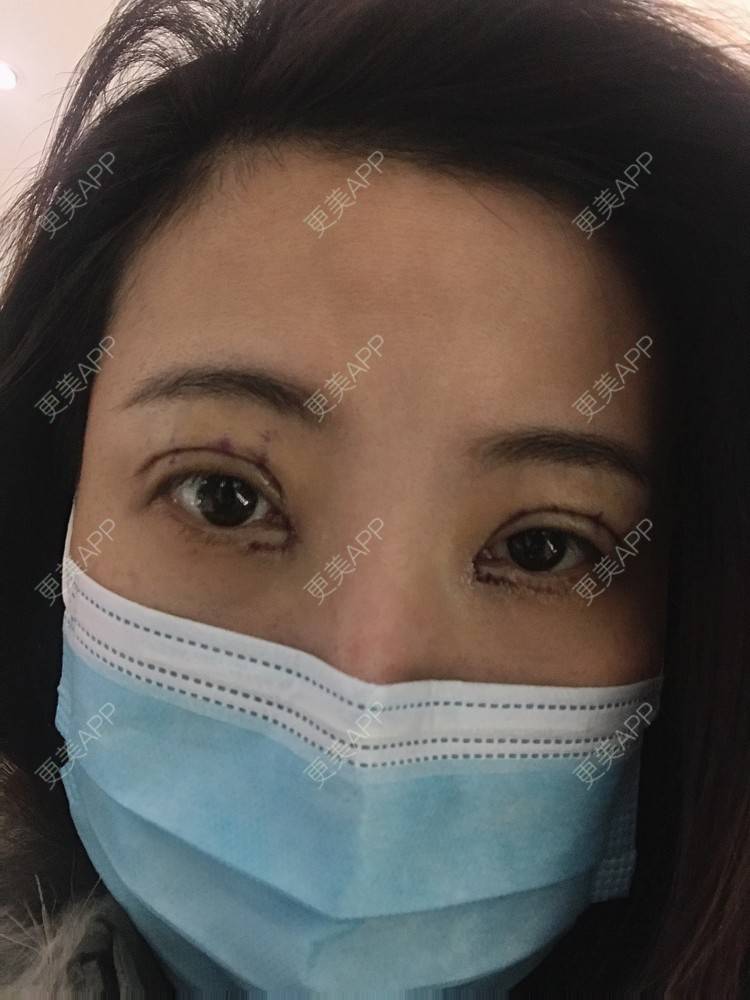 更美 - 更美用户bONdGip4QS的双眼皮经验 | 双眼皮 | 上海 | 眼部多项