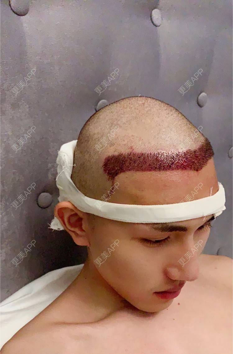 更美 - D调··的植发际线经验 | 成都