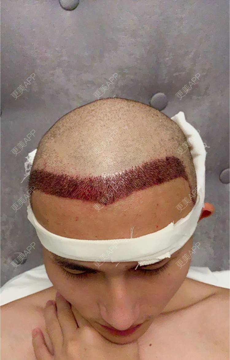 更美 - D调··的植发际线经验 | 成都