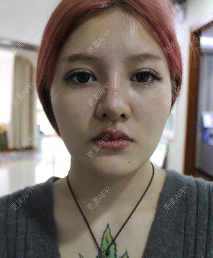 更美 - 陈玉琼 医生的全切双眼皮经验 | 全切双眼皮 | 开内眼角 | 眼部多项 | 昆明