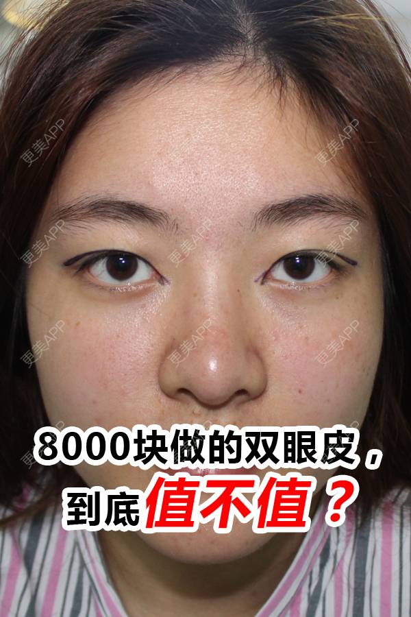 更美 - 陈玉琼 医生的全切双眼皮经验 | 全切双眼皮 | 开内眼角 | 眼部多项 | 昆明