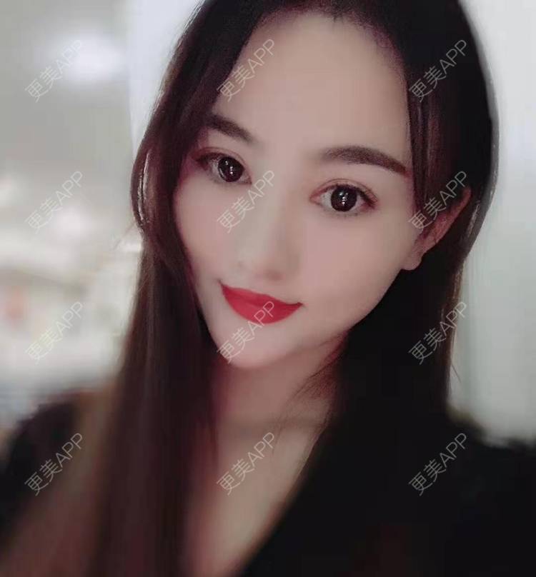 更美 - 更美用户tYzlahBO6T的植发际线经验 | 植发际线 | 深圳 | 毛发移植