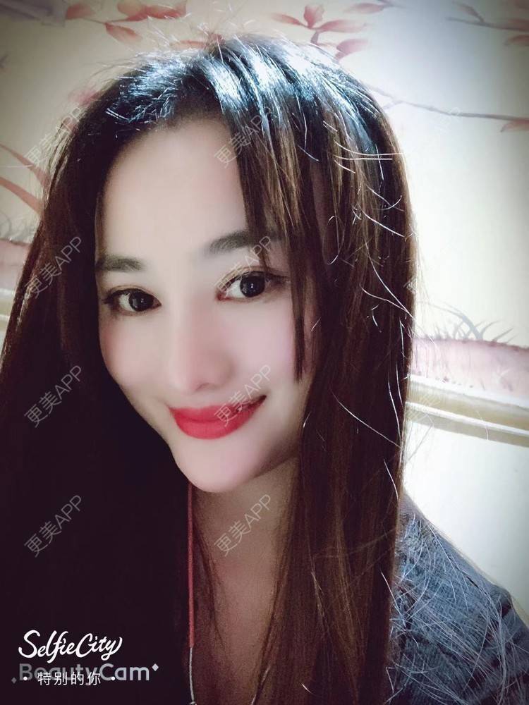 更美 - 更美用户tYzlahBO6T的植发际线经验 | 植发际线 | 深圳 | 毛发移植