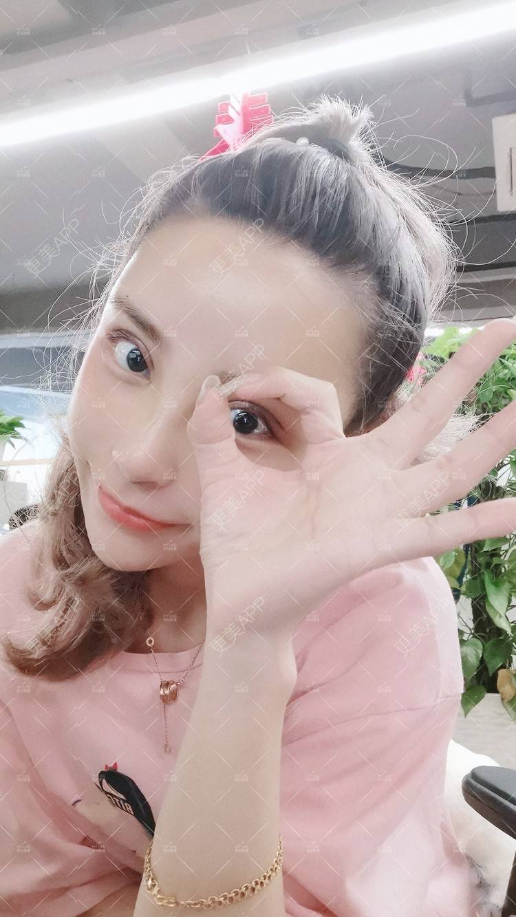 更美 - 土豆泥泥泥的双眼皮经验 | 双眼皮 | 隆鼻 | 苏州 | 自体脂肪面部填充