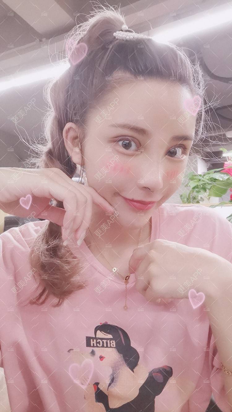 更美 - 土豆泥泥泥的双眼皮经验 | 双眼皮 | 隆鼻 | 苏州 | 自体脂肪面部填充