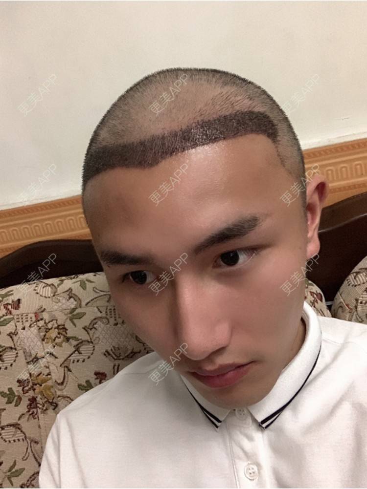 更美 - D调··的植发际线经验 | 植发际线 | 成都