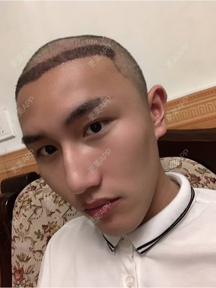 更美 - D调··的植发际线经验 | 植发际线 | 成都