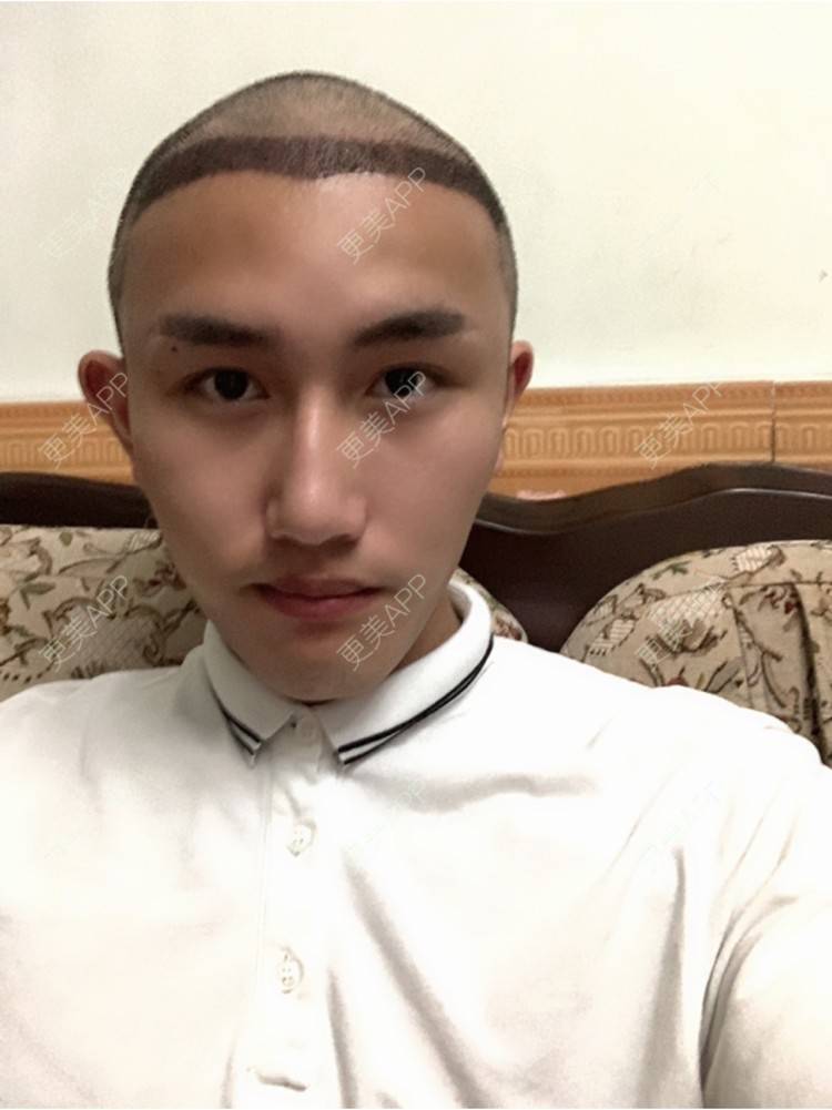 更美 - D调··的植发际线经验 | 植发际线 | 成都