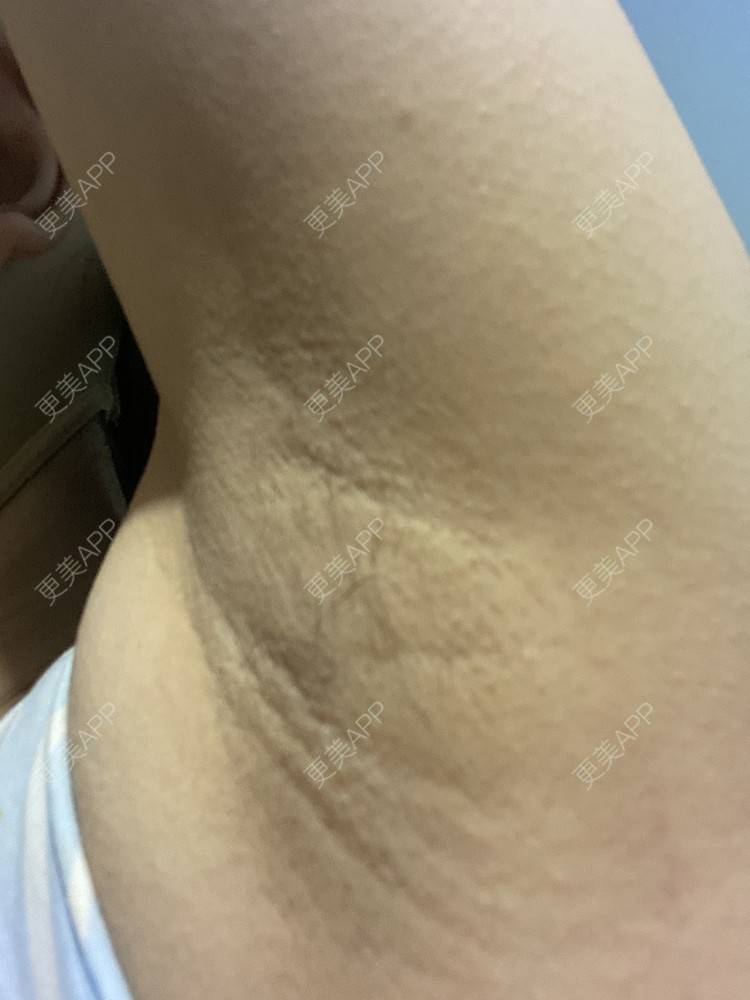 更美 - 香殿的激光脱全身毛发经验 | 激光脱全身毛发 | 成都