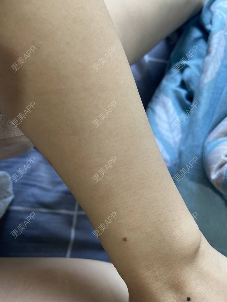 更美 - 香殿的激光脱全身毛发经验 | 激光脱全身毛发 | 成都