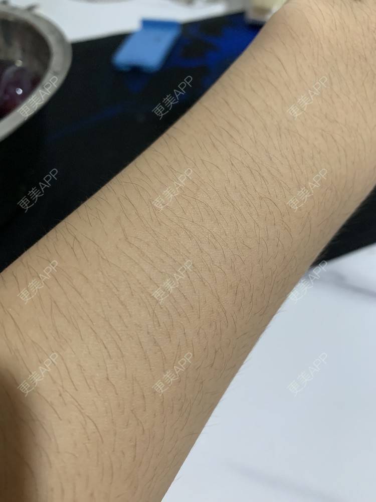 更美 - 香殿的激光脱全身毛发经验 | 激光脱全身毛发 | 成都