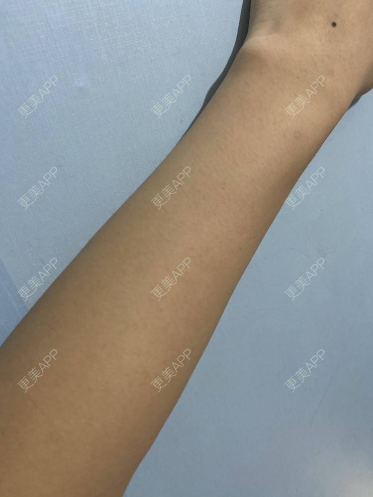 更美 - 香殿的激光脱全身毛发经验 | 成都 | 激光脱全身毛发