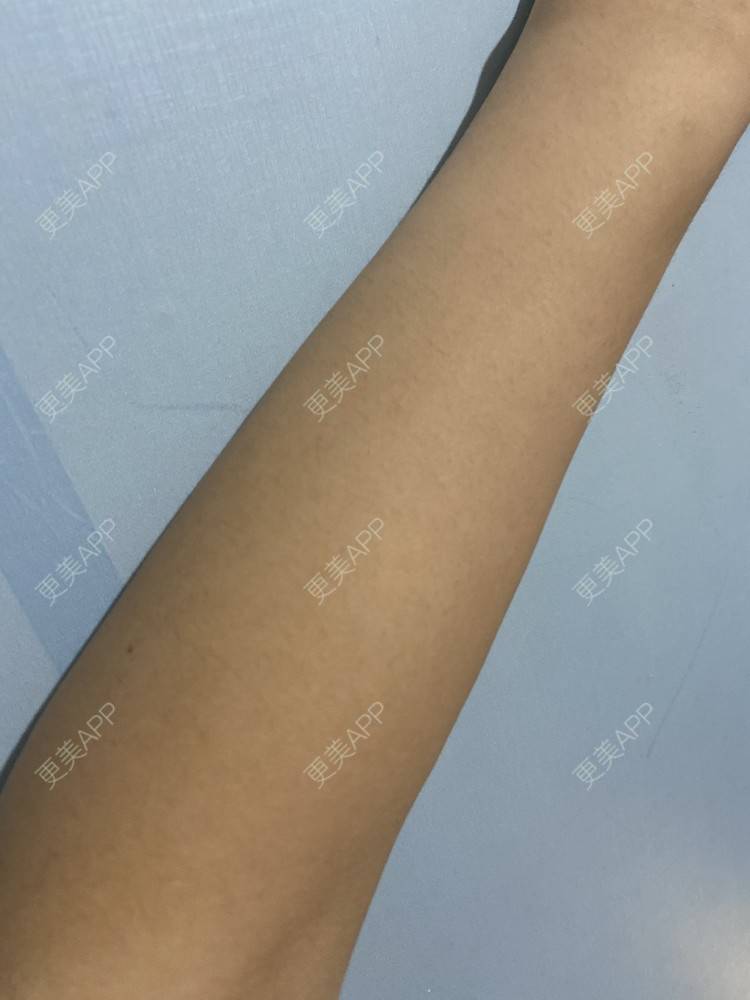 更美 - 香殿的激光脱全身毛发经验 | 成都 | 激光脱全身毛发