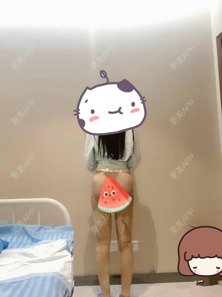 更美 - 更美用户mKvVnn0q0q的假体丰臀经验 | 假体丰臀 | 深圳