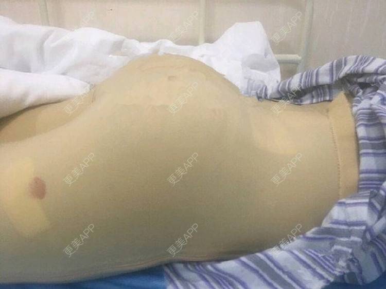 更美 - 更美用户mKvVnn0q0q的假体丰臀经验 | 假体丰臀 | 深圳