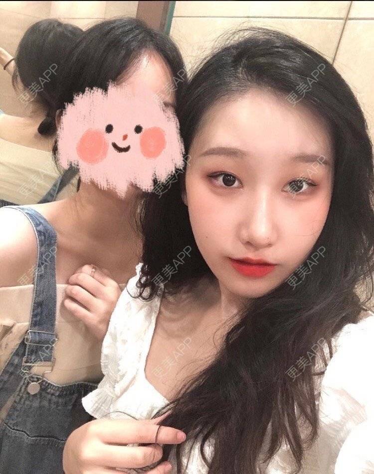 更美 - 荏苒时光岁月如梭的鼻部多项经验 | 鼻部多项 | 肋软骨隆鼻 | 重庆 | 鼻小柱延长