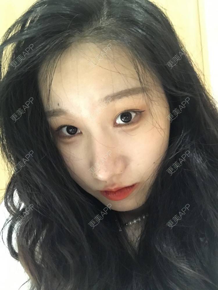 更美 - 荏苒时光岁月如梭的鼻部多项经验 | 鼻部多项 | 肋软骨隆鼻 | 重庆 | 鼻小柱延长