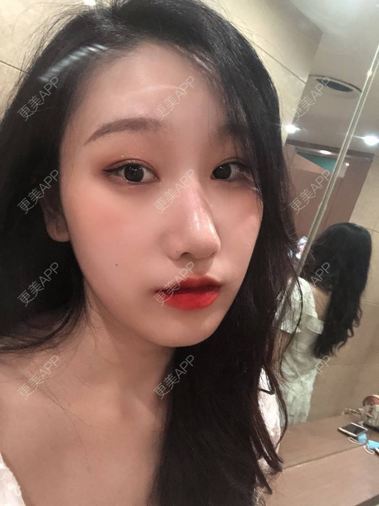更美 - 荏苒时光岁月如梭的鼻部多项经验 | 鼻部多项 | 肋软骨隆鼻 | 重庆 | 鼻小柱延长