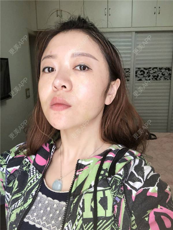 更美 - 更美用户HZtGeH6Jqi的埋线提升经验 | 视频日记 | 埋线除皱 | 重庆 | 埋线提升 | 除皱