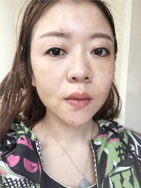 更美 - 更美用户HZtGeH6Jqi的埋线提升经验 | 视频日记 | 埋线除皱 | 重庆 | 埋线提升 | 除皱