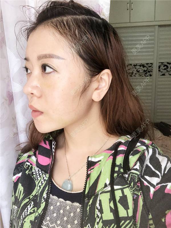 更美 - 更美用户HZtGeH6Jqi的埋线提升经验 | 视频日记 | 埋线除皱 | 重庆 | 埋线提升 | 除皱