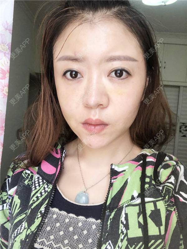 更美 - 更美用户HZtGeH6Jqi的埋线提升经验 | 视频日记 | 埋线除皱 | 重庆 | 埋线提升 | 除皱