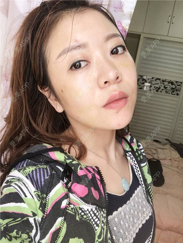 更美 - 更美用户HZtGeH6Jqi的埋线提升经验 | 视频日记 | 埋线除皱 | 重庆 | 埋线提升 | 除皱