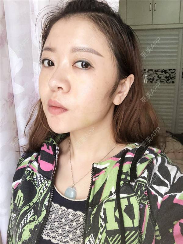 更美 - 更美用户HZtGeH6Jqi的埋线提升经验 | 视频日记 | 埋线除皱 | 重庆 | 埋线提升 | 除皱