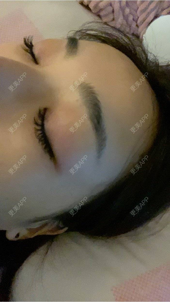 更美 - _ViViLee的自体脂肪丰太阳穴经验 | 上海 | 自体脂肪丰额头 | 自体脂肪垫眉弓