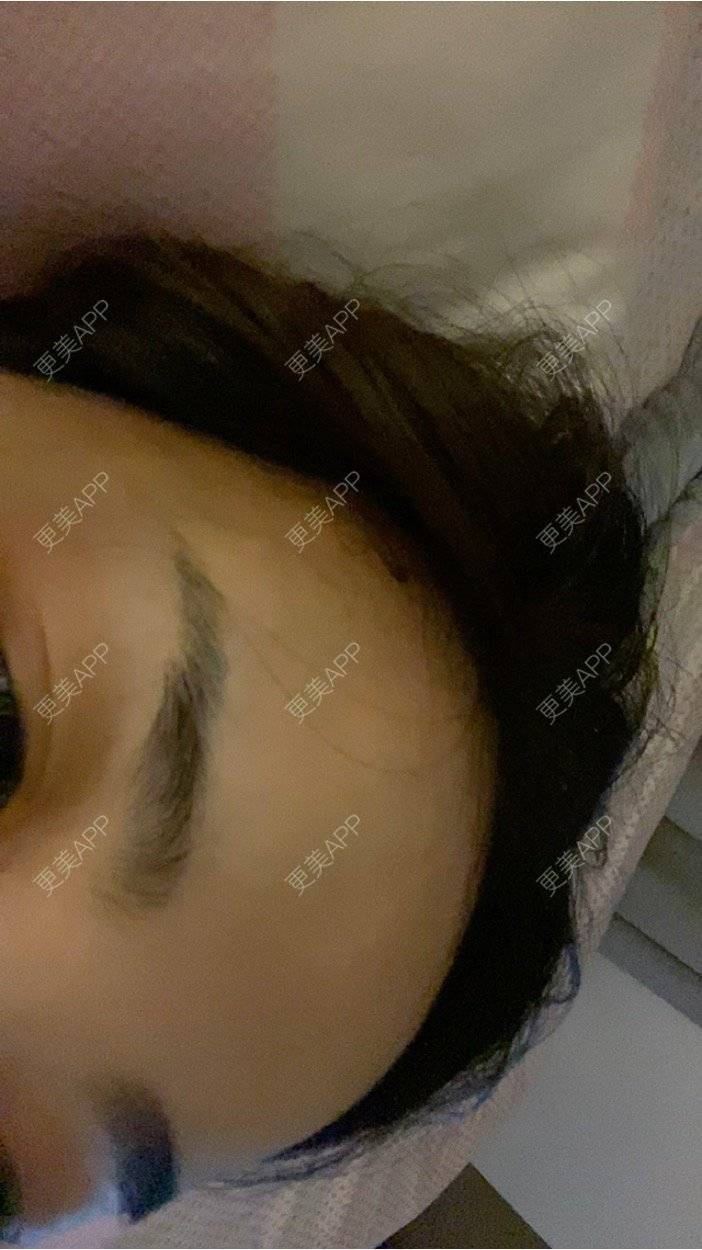 更美 - _ViViLee的自体脂肪丰太阳穴经验 | 上海 | 自体脂肪丰额头 | 自体脂肪垫眉弓