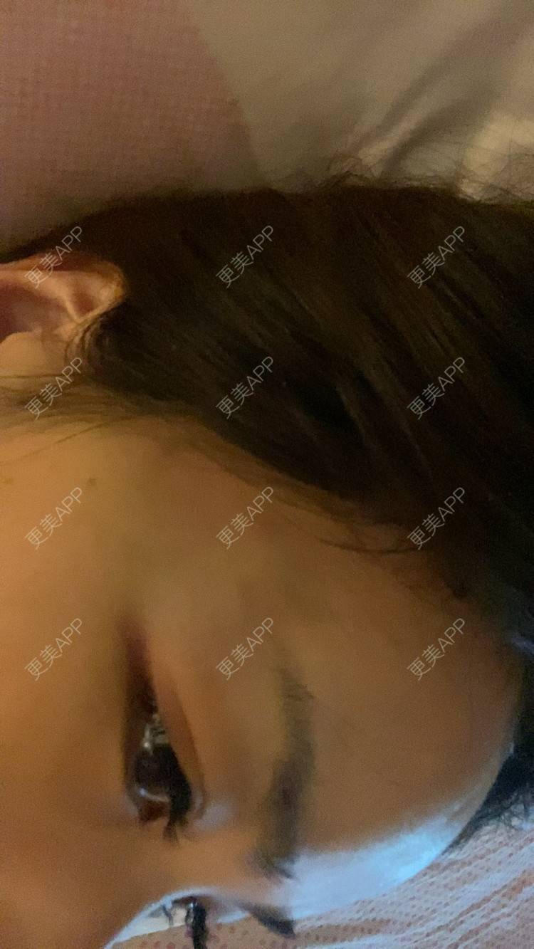 更美 - _ViViLee的自体脂肪丰太阳穴经验 | 上海 | 自体脂肪丰额头 | 自体脂肪垫眉弓