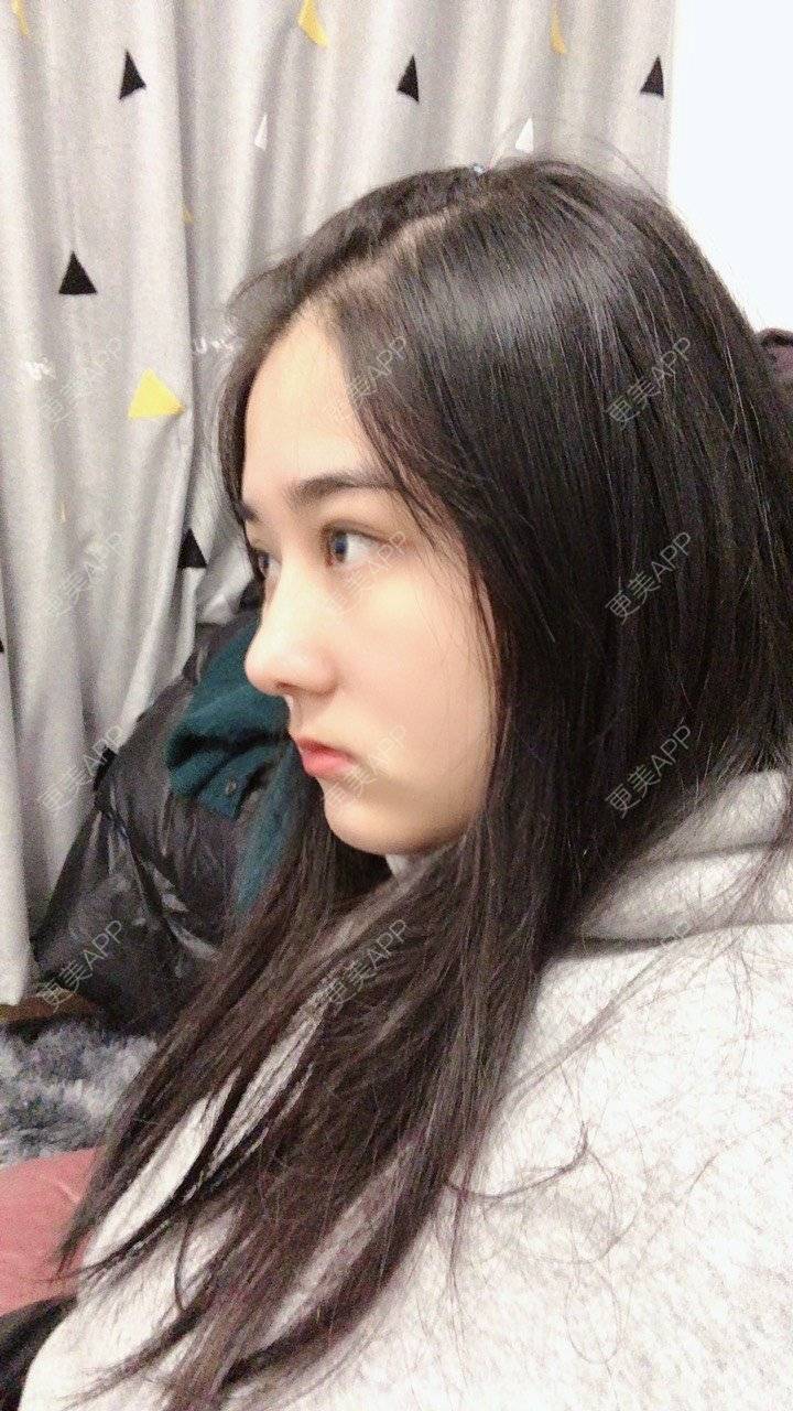 更美 - 无需解释收的鼻部多项经验 | 鼻部多项 | 膨体隆鼻 | 肋软骨隆鼻 | 重庆 | 鼻小柱延长 | 鼻形态修复
