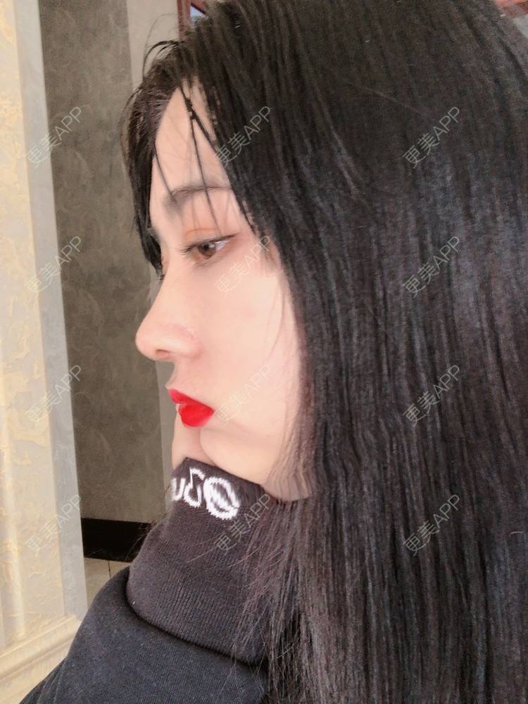 更美 - 无需解释收的鼻部多项经验 | 鼻部多项 | 膨体隆鼻 | 肋软骨隆鼻 | 重庆 | 鼻小柱延长 | 鼻形态修复