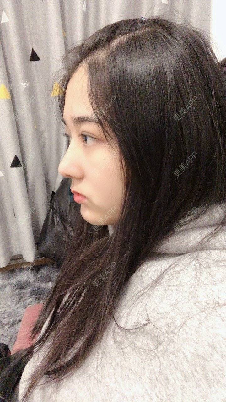 更美 - 无需解释收的鼻部多项经验 | 鼻部多项 | 膨体隆鼻 | 肋软骨隆鼻 | 重庆 | 鼻小柱延长 | 鼻形态修复