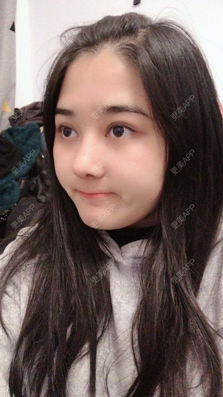 更美 - 无需解释收的鼻部多项经验 | 鼻部多项 | 膨体隆鼻 | 肋软骨隆鼻 | 重庆 | 鼻小柱延长 | 鼻形态修复