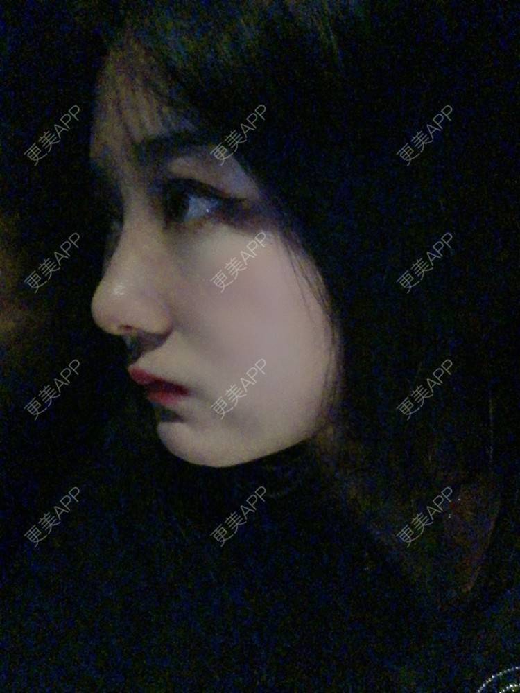 更美 - 无需解释收的鼻部多项经验 | 鼻部多项 | 膨体隆鼻 | 肋软骨隆鼻 | 重庆 | 鼻小柱延长 | 鼻形态修复