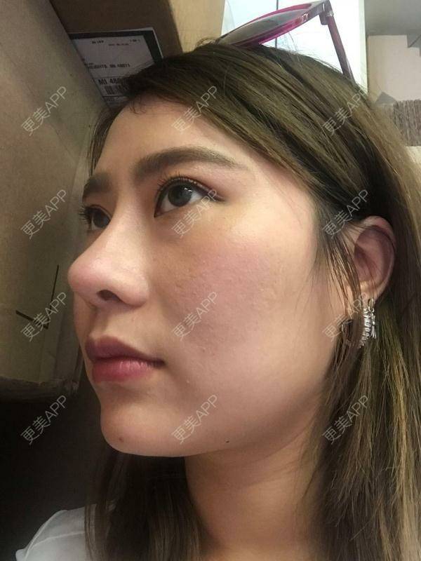 更美 - 南昌韩美美容医院的定点双眼皮经验 | 定点双眼皮 | 南昌