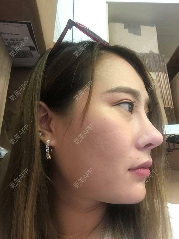 更美 - 南昌韩美美容医院的定点双眼皮经验 | 定点双眼皮 | 南昌