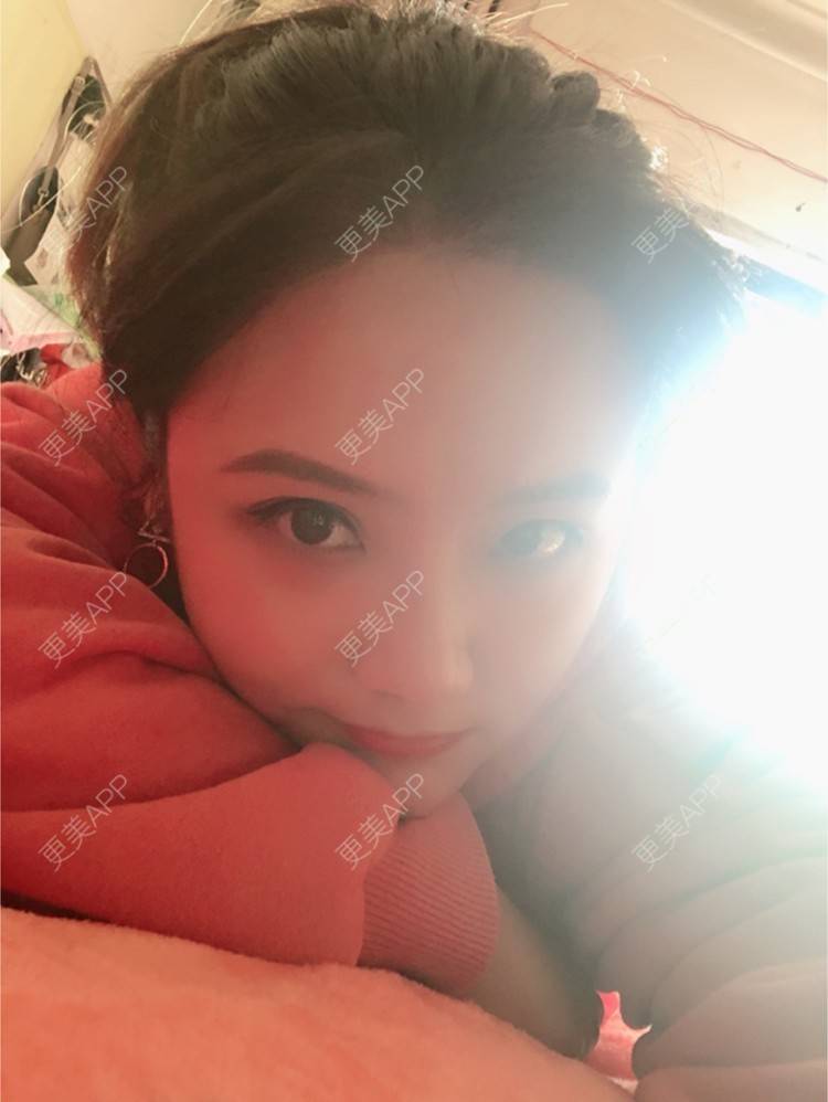 更美 - 奥多Ke。的植发际线经验 | 植发际线 | 南昌